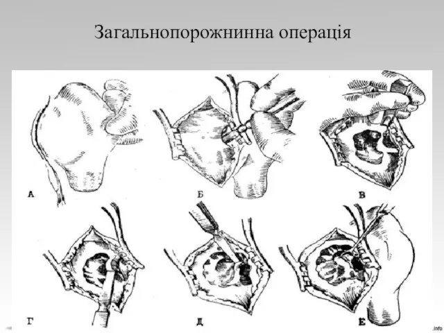 Загальнопорожнинна операція