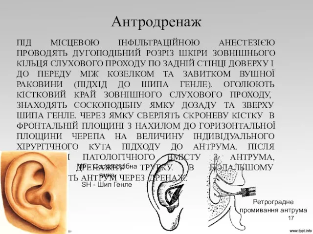 ПІД МІСЦЕВОЮ ІНФІЛЬТРАЦІЙНОЮ АНЕСТЕЗІЄЮ ПРОВОДЯТЬ ДУГОПОДІБНИЙ РОЗРІЗ ШКІРИ ЗОВНІШНЬОГО КІЛЬЦЯ