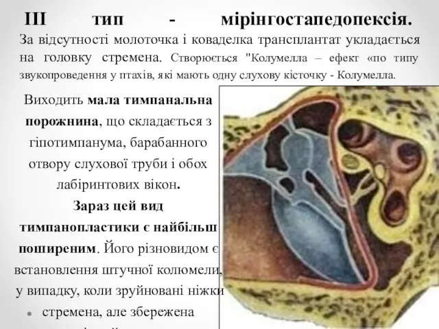 III тип - мірінгостапедопексія. За відсутності молоточка і коваделка трансплантат