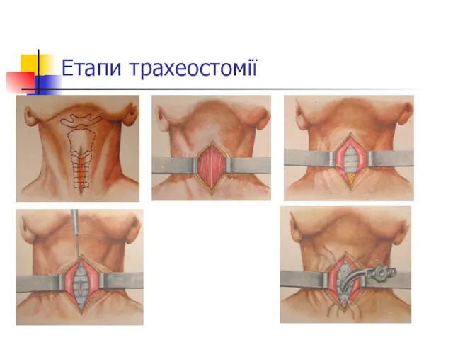 Етапи трахеостомії