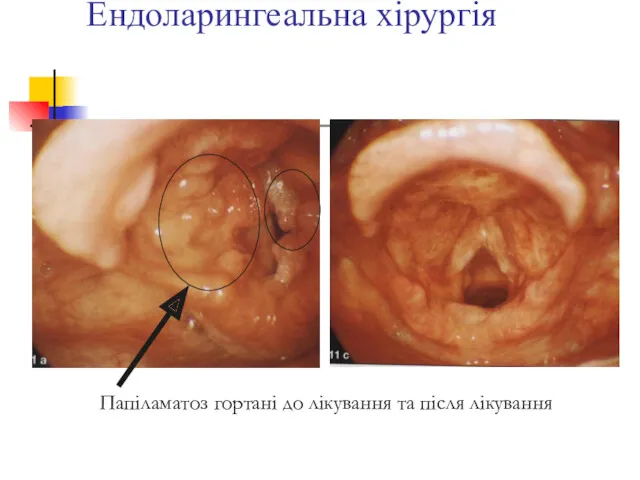 Ендоларингеальна хірургія Папіламатоз гортані до лікування та після лікування