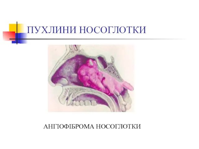 ПУХЛИНИ НОСОГЛОТКИ АНГІОФІБРОМА НОСОГЛОТКИ