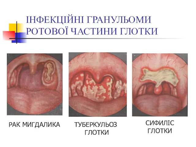 ІНФЕКЦІЙНІ ГРАНУЛЬОМИ РОТОВОЇ ЧАСТИНИ ГЛОТКИ РАК МИГДАЛИКА ТУБЕРКУЛЬОЗ ГЛОТКИ СИФИЛІС ГЛОТКИ