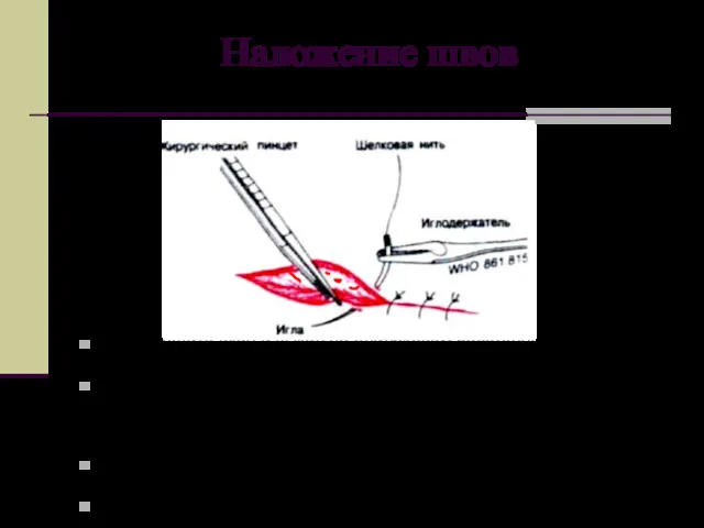 Наложение швов Произведите вкол и выкол на одинаковом расстоянии от