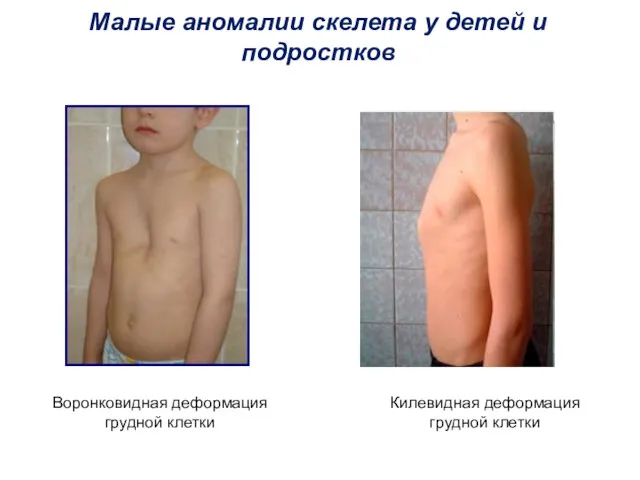 Малые аномалии скелета у детей и подростков Воронковидная деформация грудной клетки Килевидная деформация грудной клетки