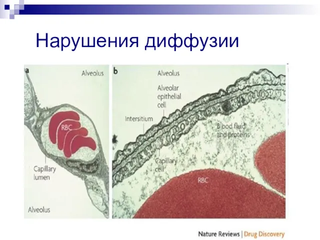 Нарушения диффузии