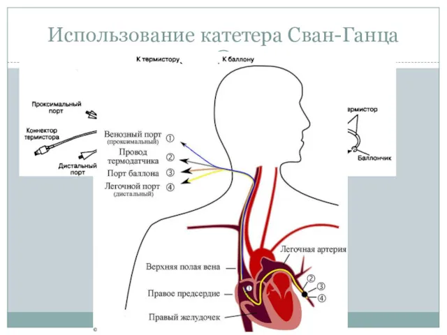 Использование катетера Сван-Ганца