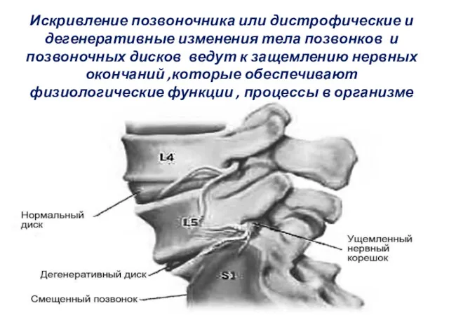 Искривление позвоночника или дистрофические и дегенеративные изменения тела позвонков и
