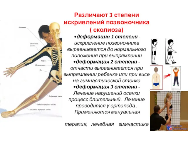 Различают 3 степени искривлений позвоночника ( сколиоза) •деформация 1 степени