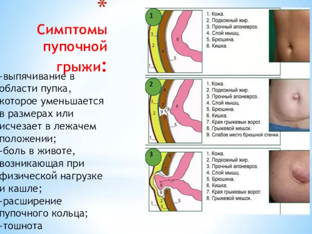 Симптомы пупочной грыжи: -выпячивание в области пупка, которое уменьшается в