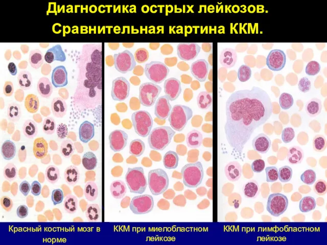 Красный костный мозг в норме ККМ при лимфобластном лейкозе ККМ при миелобластном лейкозе