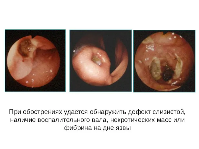 При обострениях удается обнаружить дефект слизистой, наличие воспалительного вала, некротических масс или фибрина на дне язвы