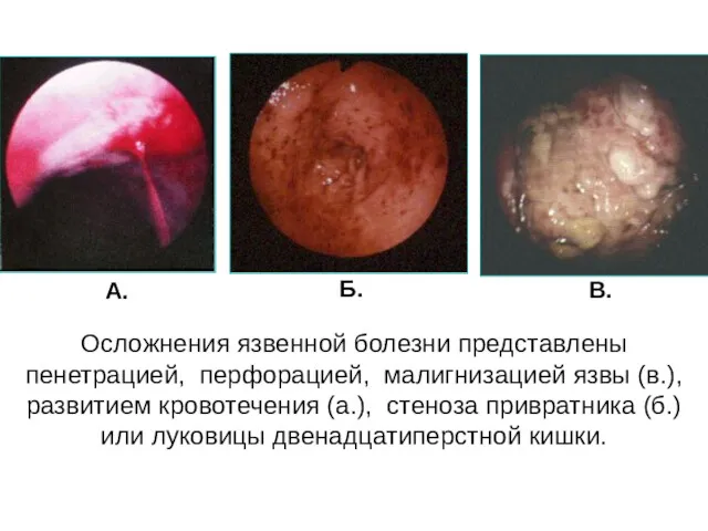 Осложнения язвенной болезни представлены пенетрацией, перфорацией, малигнизацией язвы (в.), развитием