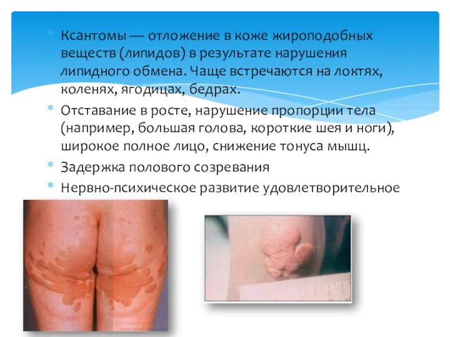 Ксантомы — отложение в коже жироподобных веществ (липидов) в результате