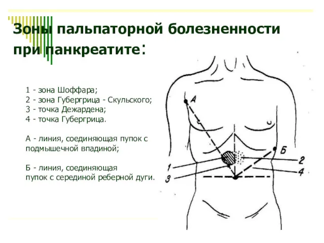 Зоны пальпаторной болезненности при панкреатите: 1 - зона Шоффара; 2 - зона Губергрица