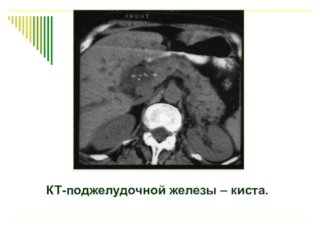 КТ-поджелудочной железы – киста.