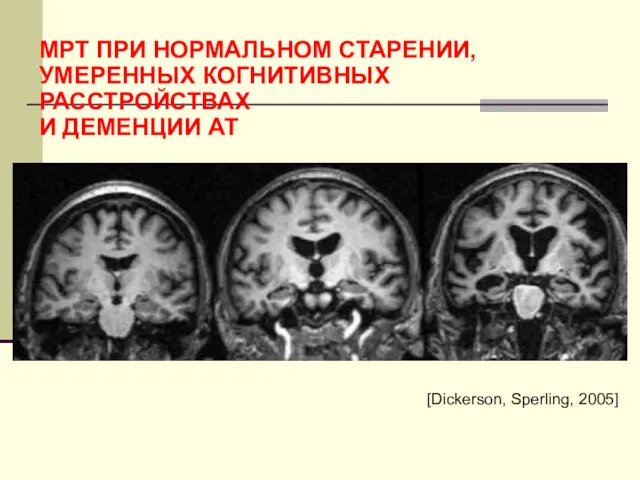 МРТ ПРИ НОРМАЛЬНОМ СТАРЕНИИ, УМЕРЕННЫХ КОГНИТИВНЫХ РАССТРОЙСТВАХ И ДЕМЕНЦИИ АТ [Dickerson, Sperling, 2005]