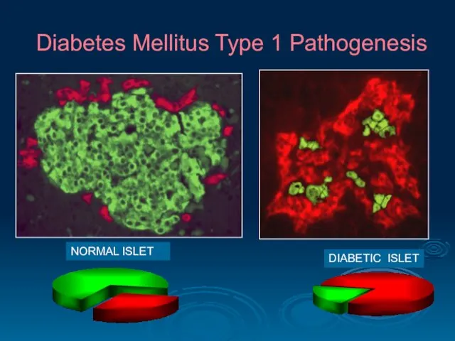 Diabetes Mellitus Type 1 Pathogenesis NORMAL ISLET DIABETIC ISLET