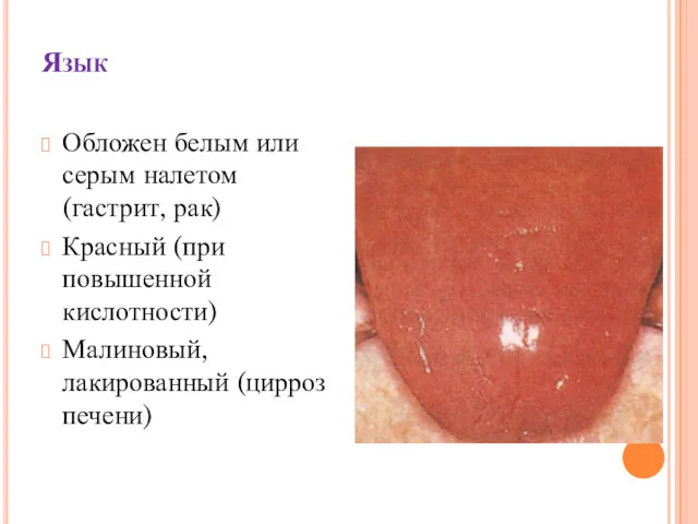 Язык Обложен белым или серым налетом (гастрит, рак) Красный (при повышенной кислотности) Малиновый, лакированный (цирроз печени)