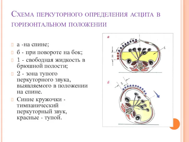 Схема перкуторного определения асцита в горизонтальном положении а -на спине;