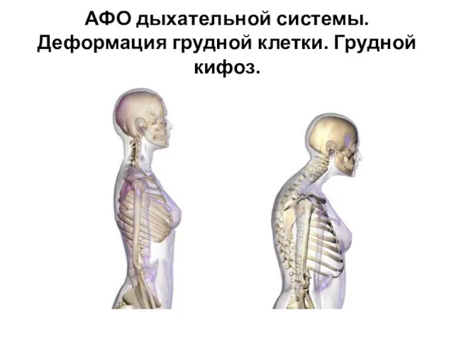 АФО дыхательной системы. Деформация грудной клетки. Грудной кифоз.