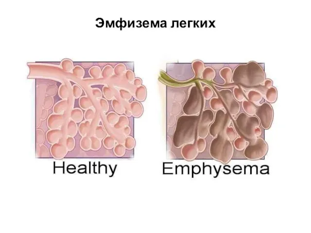 Эмфизема легких