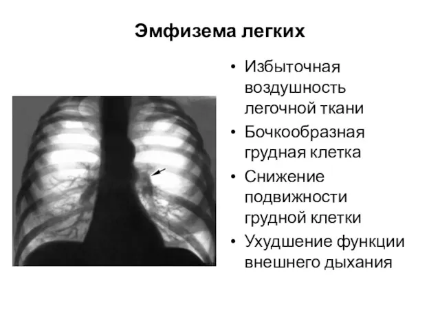 Эмфизема легких Избыточная воздушность легочной ткани Бочкообразная грудная клетка Снижение