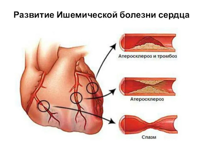 Развитие Ишемической болезни сердца