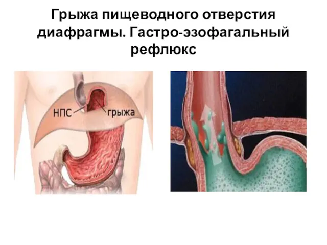 Грыжа пищеводного отверстия диафрагмы. Гастро-эзофагальный рефлюкс