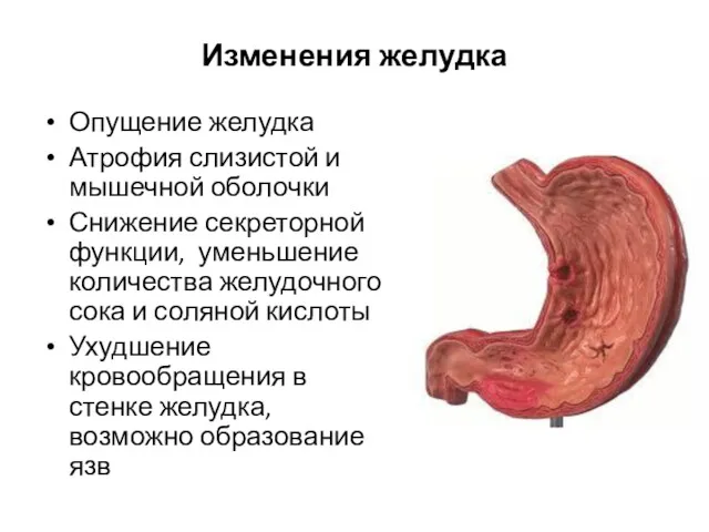 Изменения желудка Опущение желудка Атрофия слизистой и мышечной оболочки Снижение