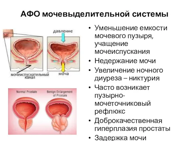 АФО мочевыделительной системы Уменьшение емкости мочевого пузыря, учащение мочеиспускания Недержание