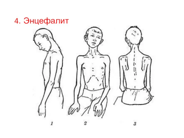 4. Энцефалит