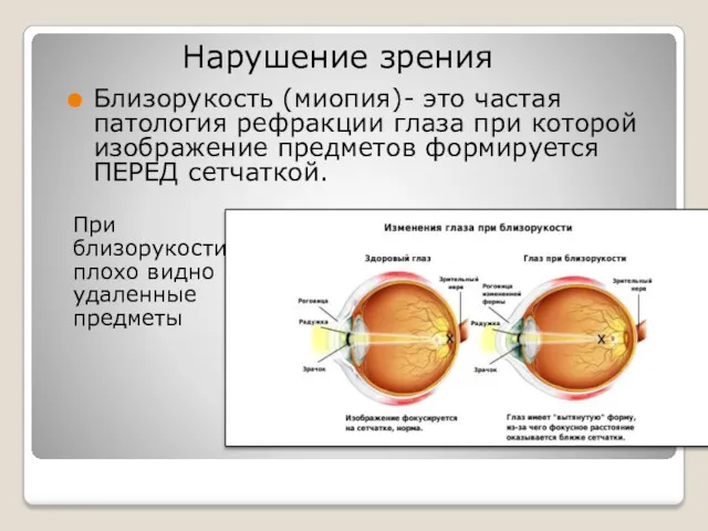 Близорукость (миопия)- это частая патология рефракции глаза при которой изображение