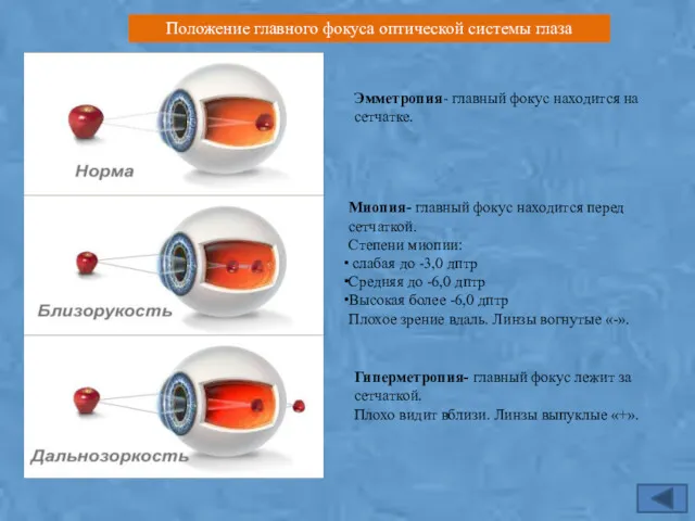 Эмметропия- главный фокус находится на сетчатке. Миопия- главный фокус находится