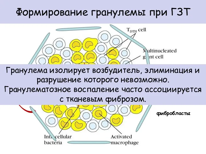 Формирование гранулемы при ГЗТ TNF-α IL-1β фибробласты Гранулема изолирует возбудитель,