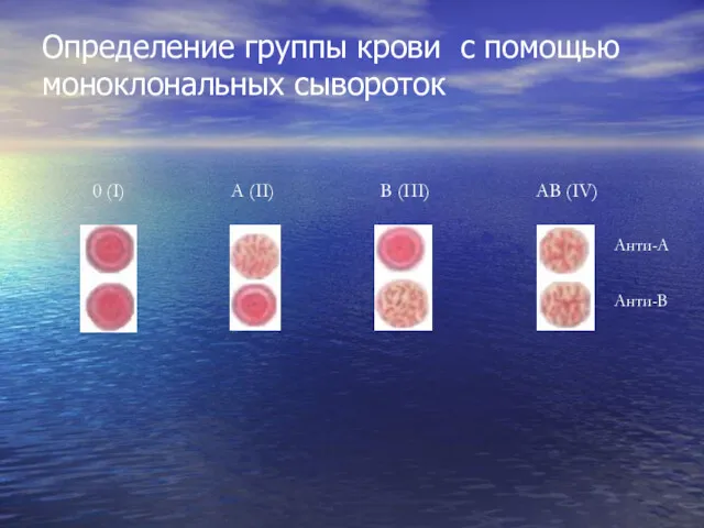 Определение группы крови с помощью моноклональных сывороток 0 (I) A