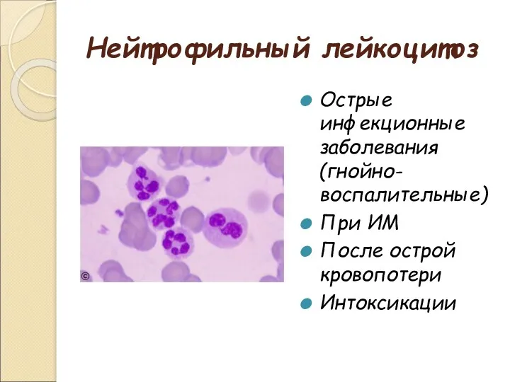 Нейтрофильный лейкоцитоз Острые инфекционные заболевания (гнойно-воспалительные) При ИМ После острой кровопотери Интоксикации