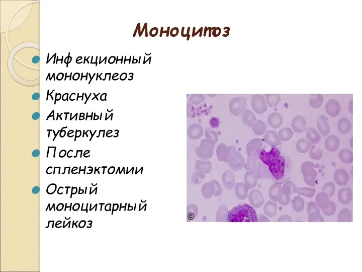 Моноцитоз Инфекционный мононуклеоз Краснуха Активный туберкулез После спленэктомии Острый моноцитарный лейкоз