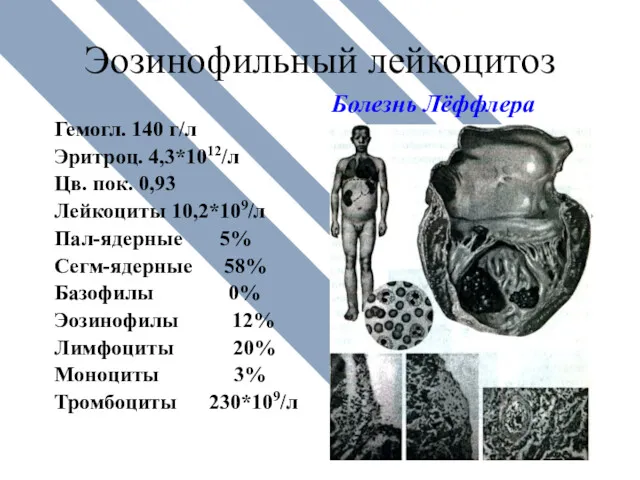 Эозинофильный лейкоцитоз Гемогл. 140 г/л Эритроц. 4,3*1012/л Цв. пок. 0,93