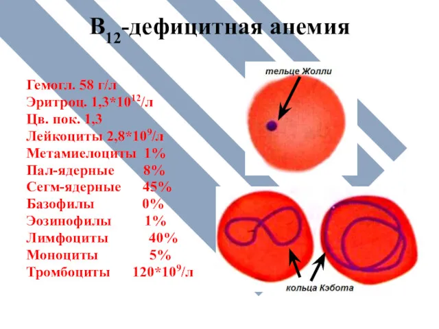 В12-дефицитная анемия Гемогл. 58 г/л Эритроц. 1,3*1012/л Цв. пок. 1,3