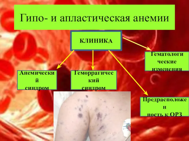 Гипо- и апластическая анемии КЛИНИКА Анемический синдром Геморрагический синдром Предрасположен ность к ОРЗ Гематологи ческие изменения