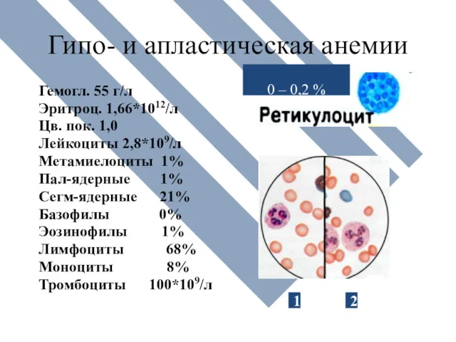 Гипо- и апластическая анемии Гемогл. 55 г/л Эритроц. 1,66*1012/л Цв.