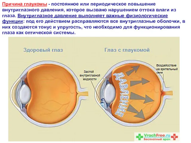 Причина глаукомы - постоянное или периодическое повышение внутриглазного давления, которое