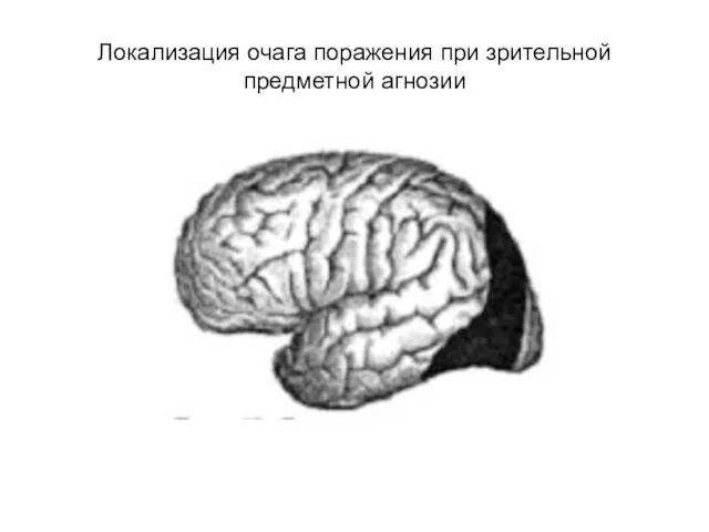 Локализация очага поражения при зрительной предметной агнозии