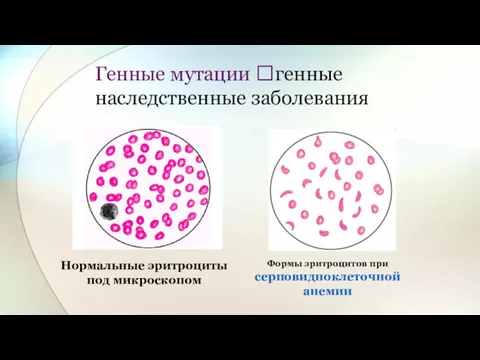 Генные мутации ?генные наследственные заболевания Нормальные эритроциты под микроскопом Формы эритроцитов при серповидноклеточной анемии