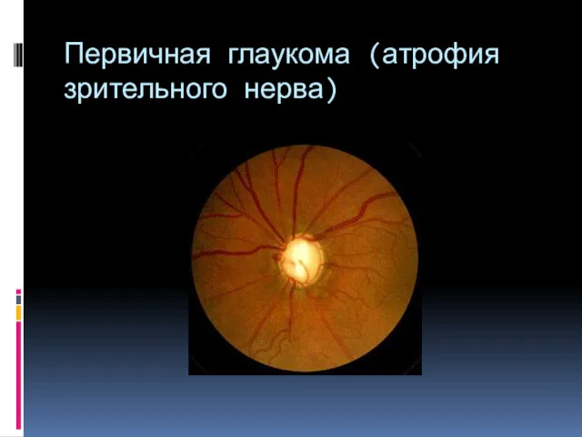 Первичная глаукома (атрофия зрительного нерва)