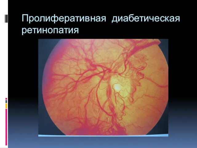 Пролиферативная диабетическая ретинопатия