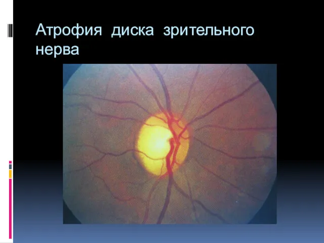 Атрофия диска зрительного нерва