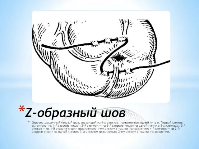 Серозно-мышечный узловой шов, состоящий из 4-х стежков, наложен-ных одной нитью.