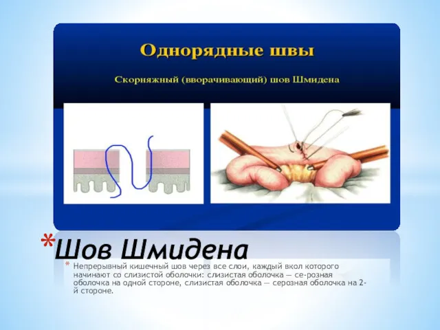 Непрерывный кишечный шов через все слои, каждый вкол которого начинают